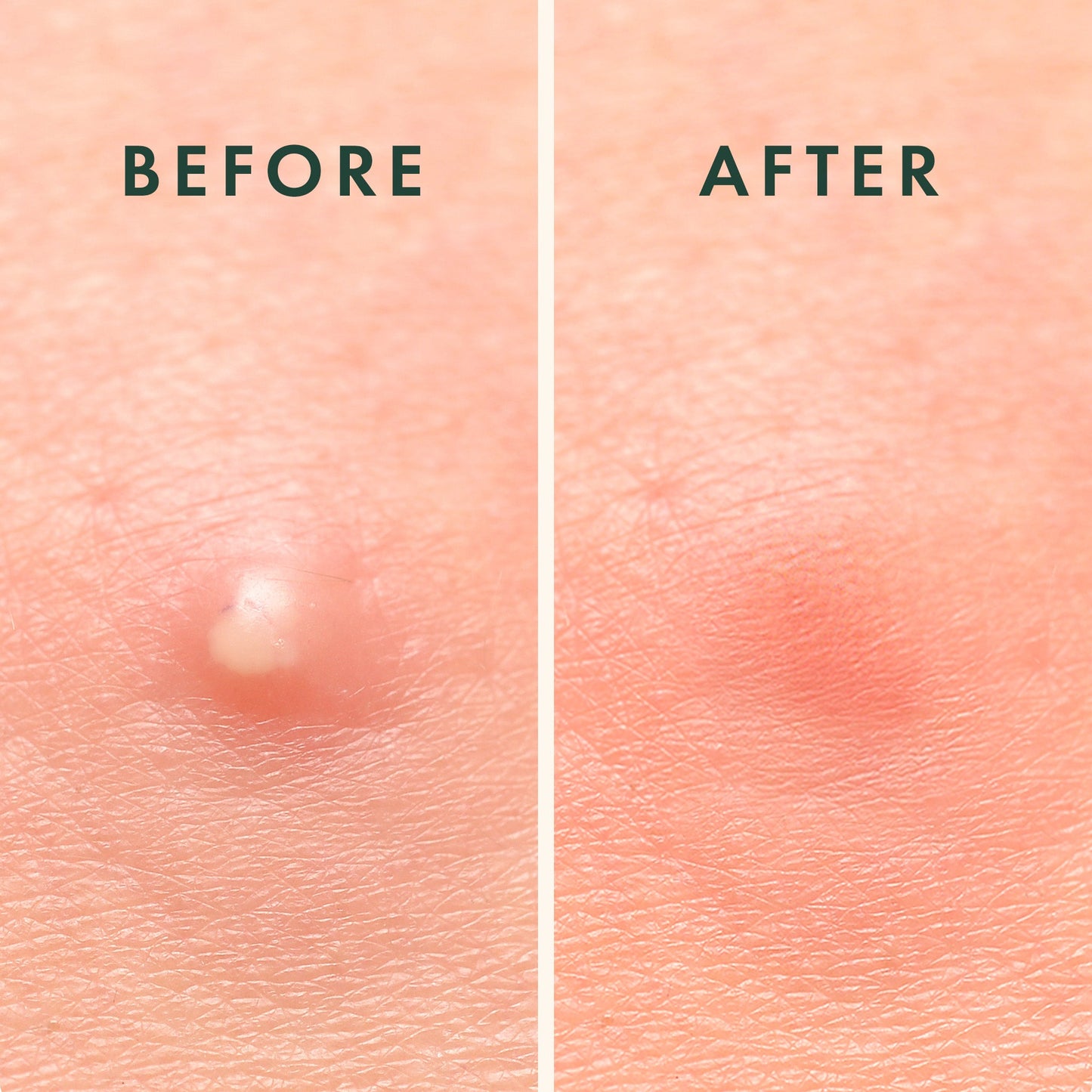 Rael Invisible + Microcrystal + Retinol Patch Bundle